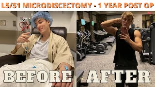 L5S1 Microdiscectomy 1 year post op [upl. by Robb]