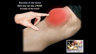 Prepatellar Bursitis Anterior knee pain and swelling [upl. by Inahet]