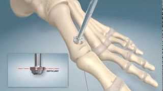 1st MTPJ arthrodesis procedure [upl. by Cornela]