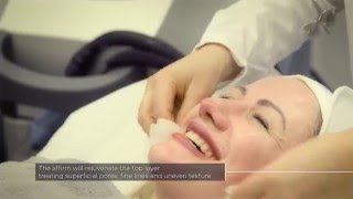 Laser Skin Rejuvenation with Cynosure’s Multiplex Affirm System at The Laser and Skin Clinic [upl. by Ingham]