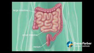 Ulcerative Colitis versus Crohns Disease Animation [upl. by Hgieliak876]