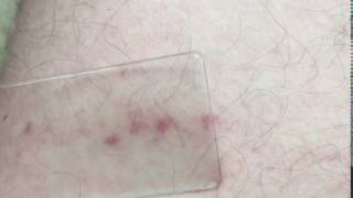 Glass test  Meningitis rash [upl. by Bonar279]