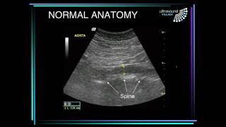 Aneurisma de aorta abdominal [upl. by O'Kelly558]