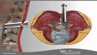 Lumbar Microdiscectomy  Spine Center Northern Nevada Northern California  Spine Surgery [upl. by Docilu]