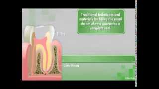 GuttaFlow2 D Root Canal Filling System [upl. by Sidney]