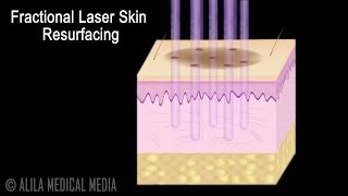 Traditional versus Fractional Laser Skin Resurfacing Procedure Animation [upl. by Dellora]