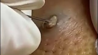 2020 Comedones Popping Dermatology Blackheads Zits and Whiteheads Cysts [upl. by Turino]