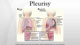 Pleurisy [upl. by Tnilk362]