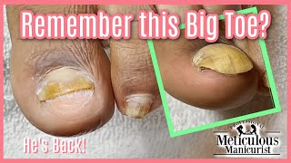 Return of the Detached Toenail with Amazing Pedicure Transformation for Men [upl. by Jaret]