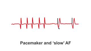 What Makes Your Pacemaker Tick [upl. by Wetzel]