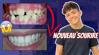 TOUT SUR MES DENTS évolution douleurs [upl. by Norma30]