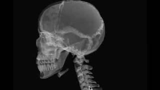 Axiolateral Oblique Mandible [upl. by Anor]