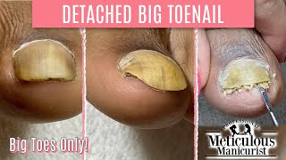 👣Big Toes Only  How To Pedicure Transformation for Men on Detached Toenails👣 [upl. by Severen890]