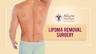 Multiple Lipoma Removal Surgery at Alluremedspa  DrMilan Doshi [upl. by Ynnol186]