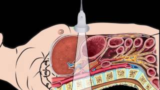 Thoracic Endovascular Aortic Aneurysm Repair in Dallas [upl. by Woolley259]