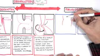 Bowel Obstruction  Causes and Pathophysiology [upl. by Lillywhite]