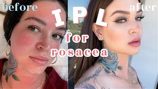 How I treat my ROSACEA  IPL Photofacial 👼🏼 THE FACIAL THAT CHANGED MY FACE [upl. by Asile]