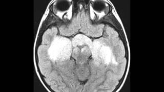 Optic Pathway Glioma [upl. by Ulu271]