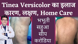 Tinea Versicolar Treatment  भभूतीसीपसहुआकरोडिया का इलाज  Pityriasis Versicolor  In Hindi [upl. by Yknip]