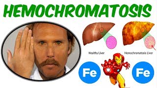 Hemochromatosis Iron Overload Disorder [upl. by Miksen370]