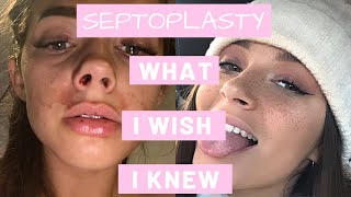 How To Survive A Septoplasty  What I Wish I Knew [upl. by Aerdua]