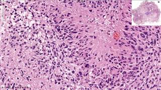 Glioblastoma  Histopathology [upl. by Mackenie]