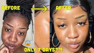 HOW I CLEARED MY SKIN in 1 WEEK and LIGHTENED my dark under eye circles [upl. by Panter497]