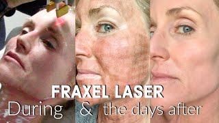 My FRACTIONAL CO2 LASER Experience  The FULL Treatment amp the DAYS following  BEFORE amp AFTER Fraxel [upl. by Domela377]