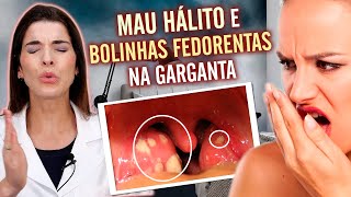 ACABE com as Bolinhas Fedorentas da Garganta e o MAU HÁLITO [upl. by Llevad]