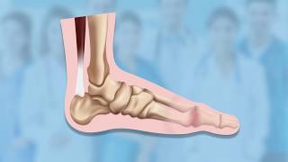 Big Toe Arthritis Symptoms  Ask Dr Silverman [upl. by Aliek621]