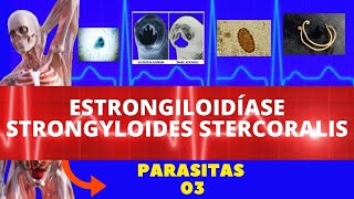 ESTRONGILOIDÍASE  STRONGYLOIDES STERCORALIS VERMINOSE  PARASITOLOGIA  INFECTOLOGIA [upl. by Amocat]