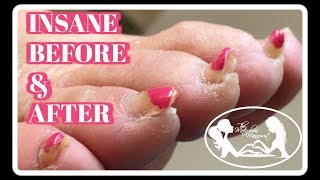 Pedicure Tutorial Elderly Thick Toenails Growing Up Transformation [upl. by Ednarb]