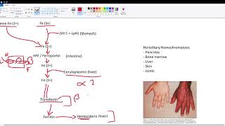 Iron Fe Metabolism  Hereditary Hemochromatosis [upl. by Eintihw]