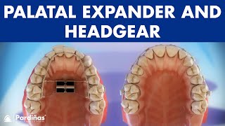 Orthodontic devices  Palatal expander and headgear © [upl. by Crutcher892]