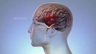 What Happens In Your Body During Migraine  WebMD [upl. by Manchester]