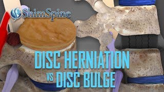 Disc Herniation vs Disc Bulge [upl. by Cosetta]