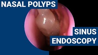 Nasal polyps  PHACON Sinus Patient Meyer [upl. by Nakashima]