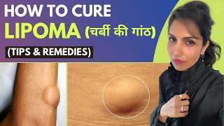 How To Cure Lipoma Naturally चर्बी की गांठ [upl. by Photina]