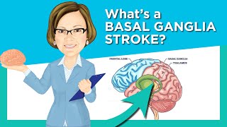 Basal Ganglia Stroke [upl. by Jaquith]