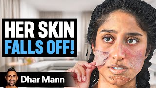 Girl Whose SKIN FALLS OFF  Dhar Mann Studios [upl. by Iluj]