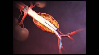 Cirurgia Endovascular de Aneurisma da Aorta Abdominal [upl. by Krute]