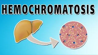 Hemochromatosis [upl. by Anai]