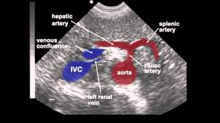 Aneurisma da aorta abdominal [upl. by Backler742]