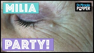 Todays Milia Extractions  Dr Pimple Popper [upl. by Fifi863]